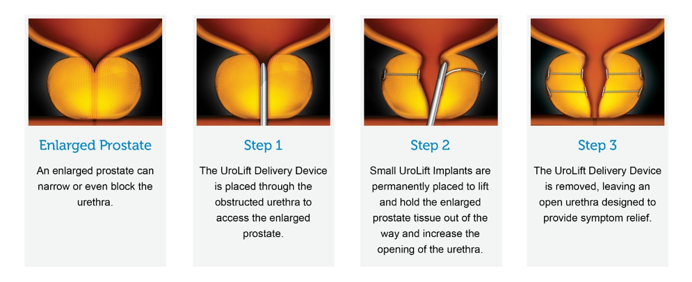 How Does The UroLift® System Work? BPH Treatment Omaha UroLift® Enlarged Prostate Treatment Omaha