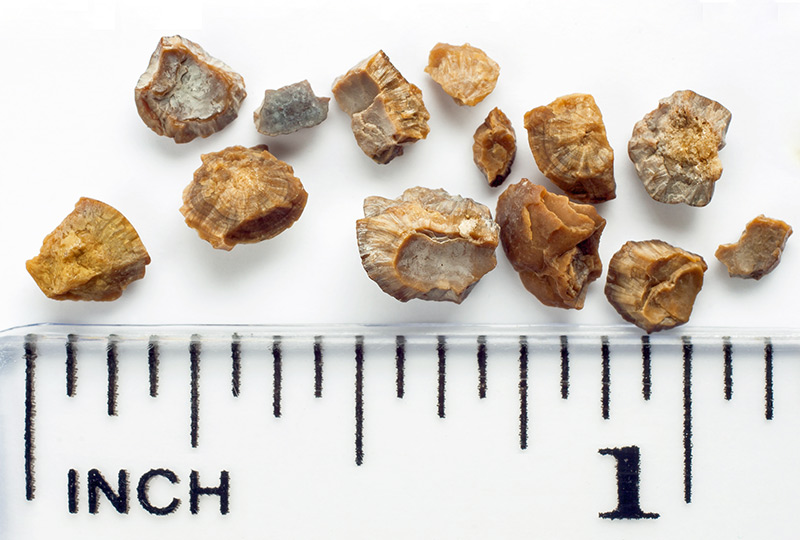 Kidney Stones: Symptoms, Types, Causes, & Treatment