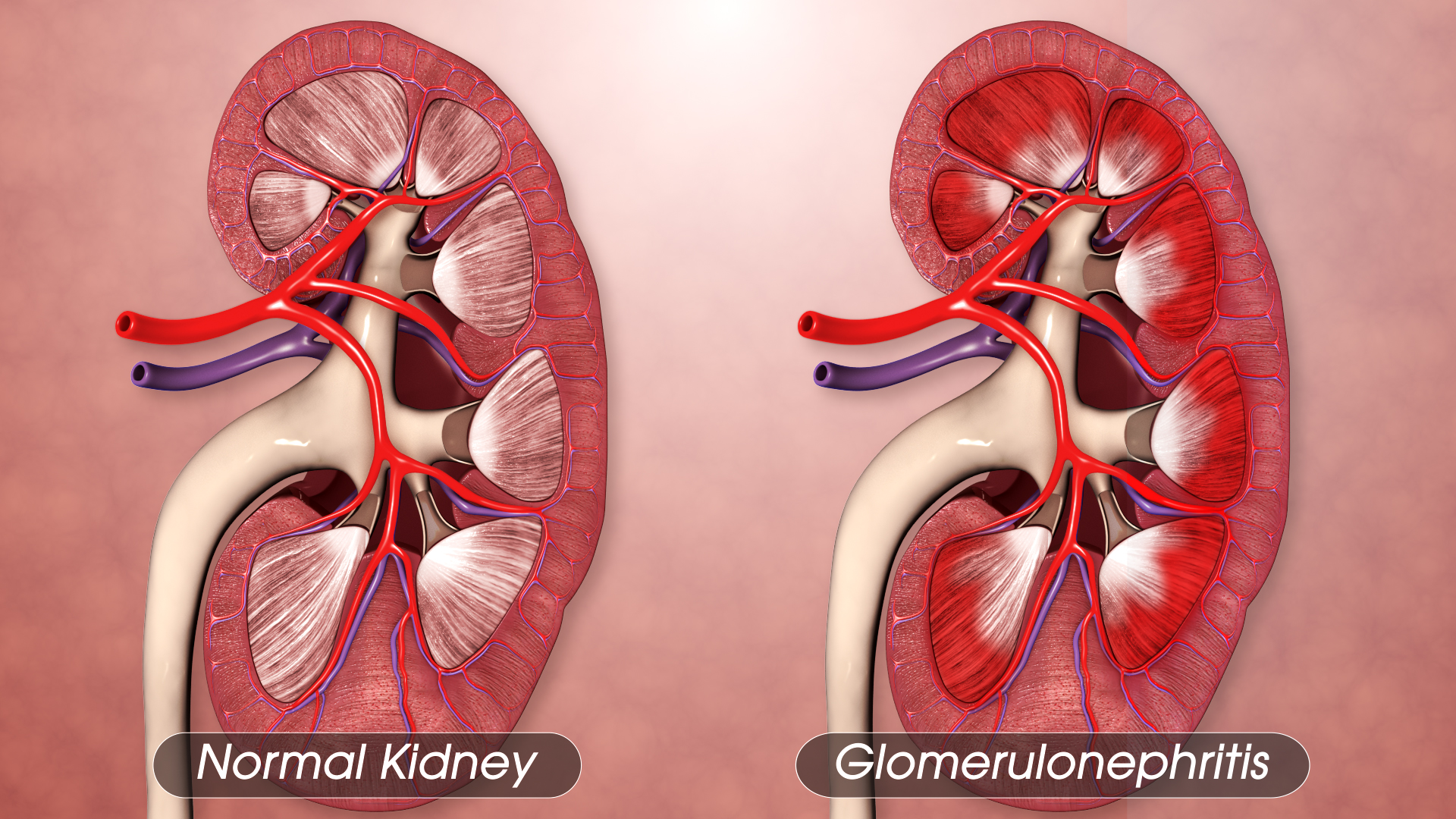 glomerulonephritis causes symptoms treatment Omaha Urologists