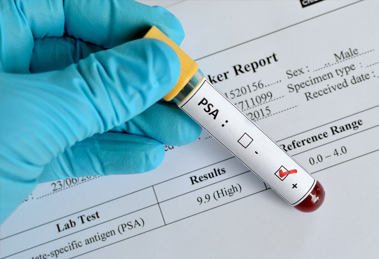 Why A PSA Test For Prostate Cancer Is Important?
