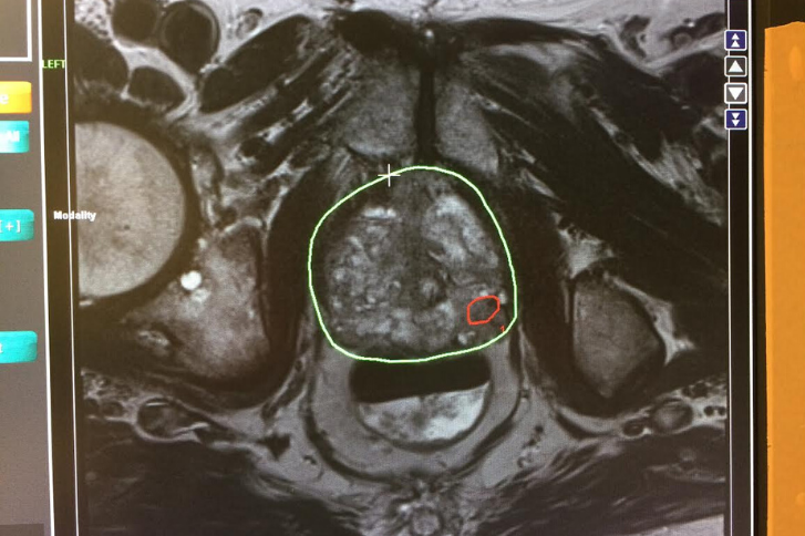 Using Biopsy to Detect Prostate Cancer