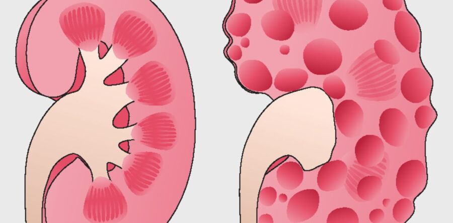Polycystic Kidney Disease