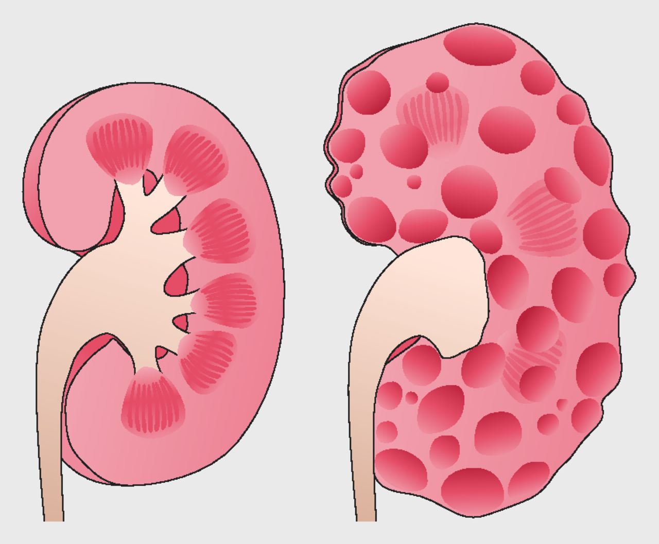 Polycystic Kidney Disease Treatment