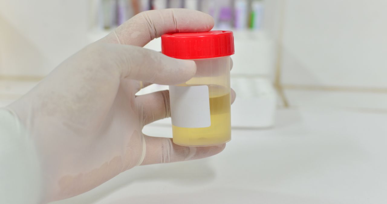 urine test sample - blood in urine and not know