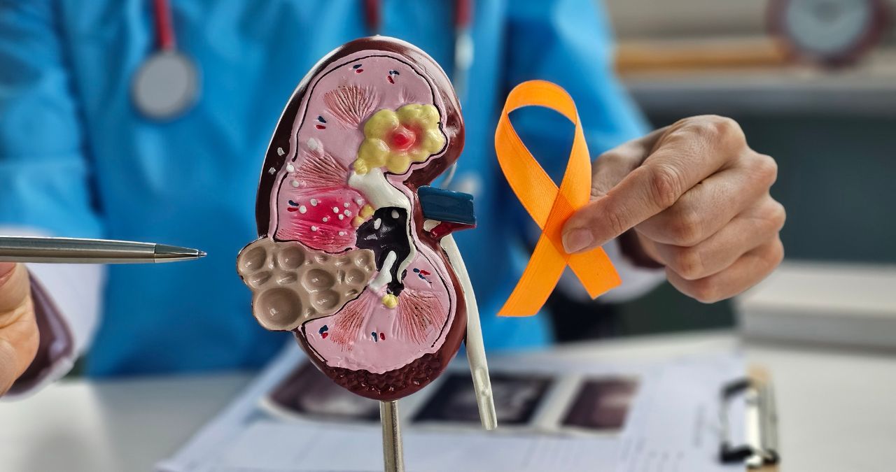 Understanding Kidney Cancer Staging